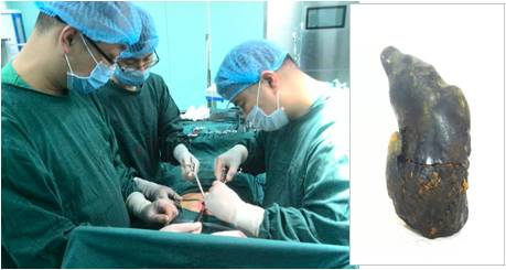 县中医院为患者摘除巨型胆总管结石