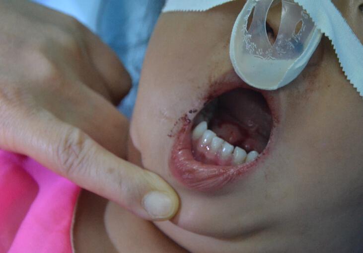 险，水龙头倒吸致女童口喉重伤