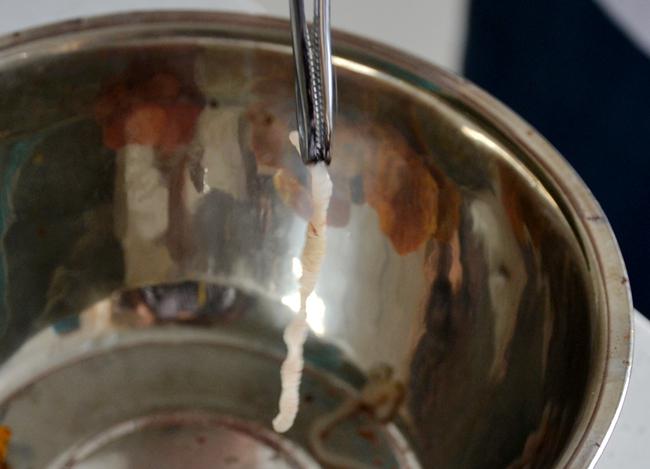 县中医院巧手取出暗藏腹内寄生虫