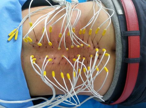 县中医院推广使用内热针疗法