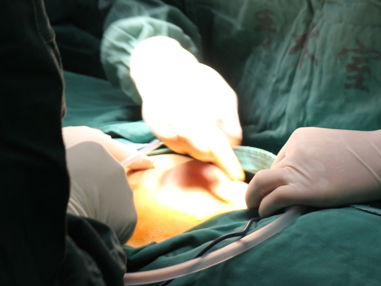 肚子上“长”了一个包 手术取出竟是一根铁筷