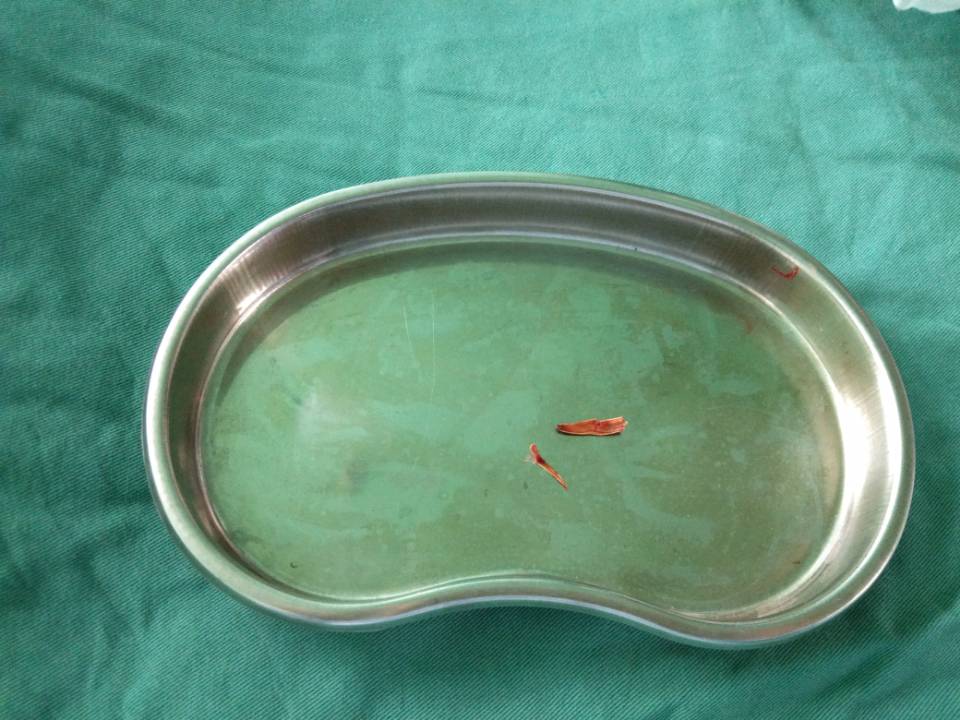 两次手术后复发 “真凶”竟是瓜子壳？