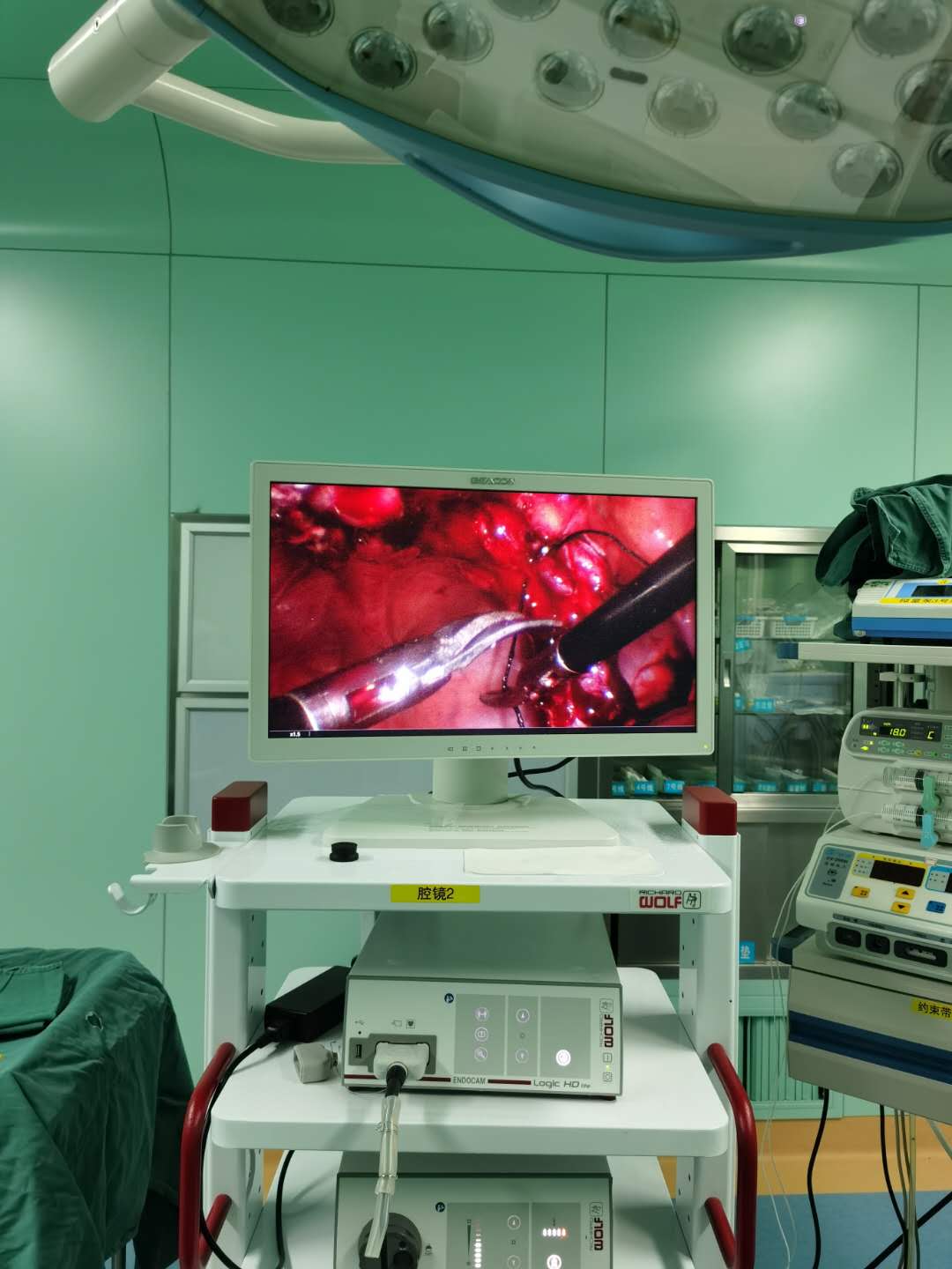 竹溪县中医院外一科独立完成首例腹腔镜下先天性脐漏手术